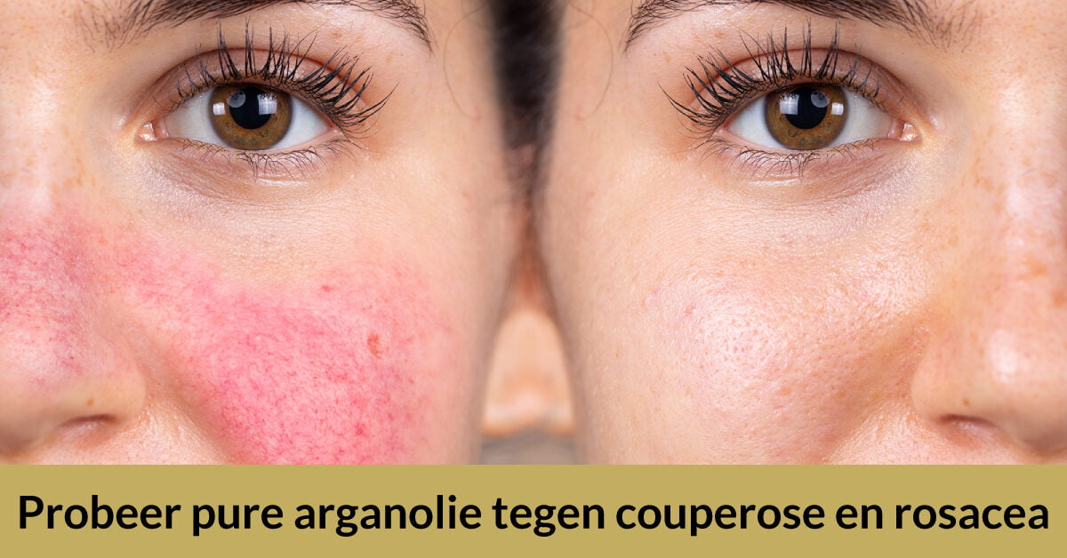 2 helften vrouwengezicht rosacea couperose behandelen pure arganolie voor en na