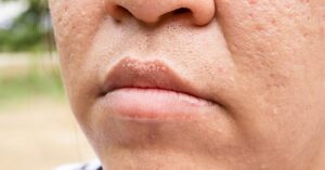 6 Makkelijke Stappen tot een Wereld Vrij Van Acnelittekens