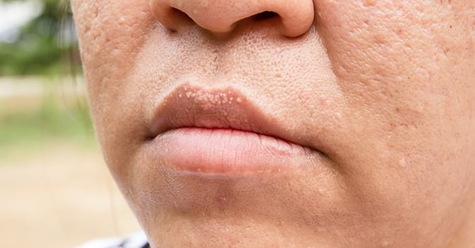 6 Makkelijke Stappen tot een Wereld Vrij Van Acnelittekens