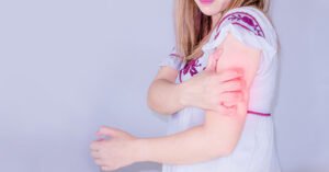 5 voedingstips tegen de jeuk en roodheid van eczeem