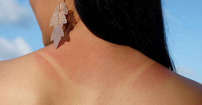 Zonverbrande Rug Vrouw