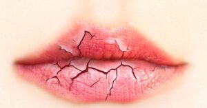 Arganolie, De Oplossing Voor Gebarsten Lippen