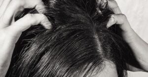 Arganolie En De Behandeling Van Psoriasis