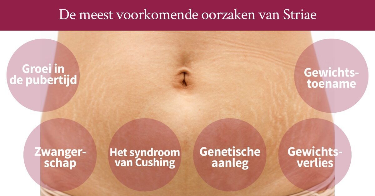 Buik striae
