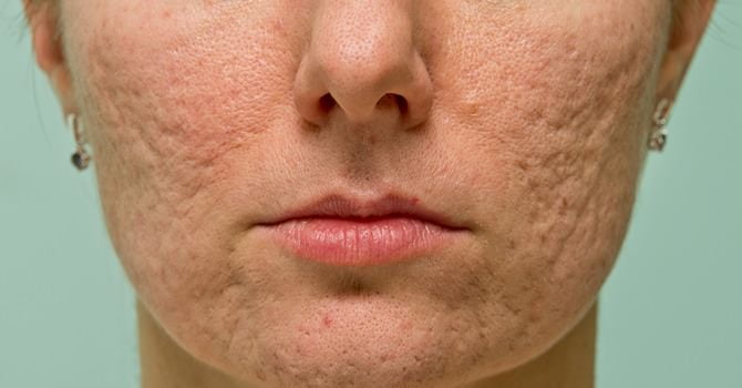 Cystische Acne, Acnelittekens en Spataderen Bestrijden