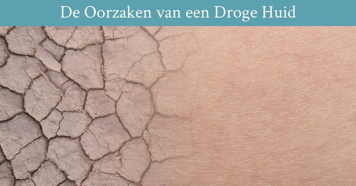 De Oorzaken van een Droge Huid