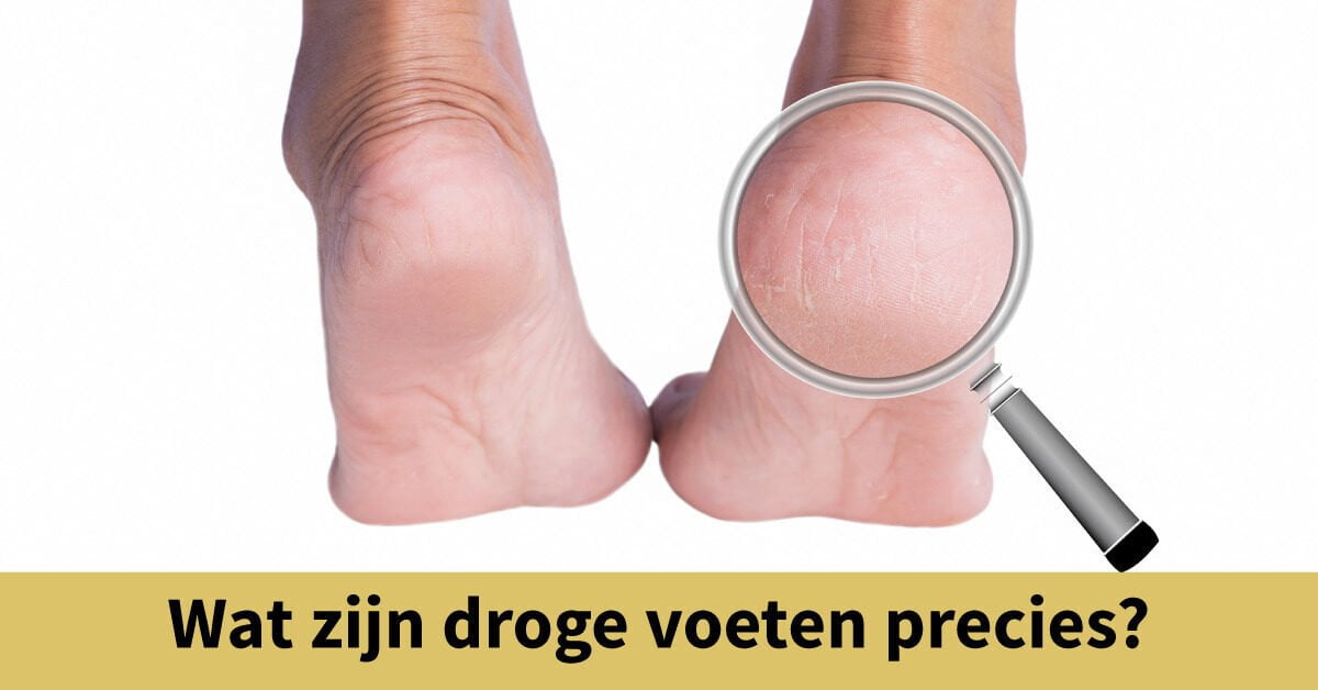 droge hiel voeten vergrootglas
