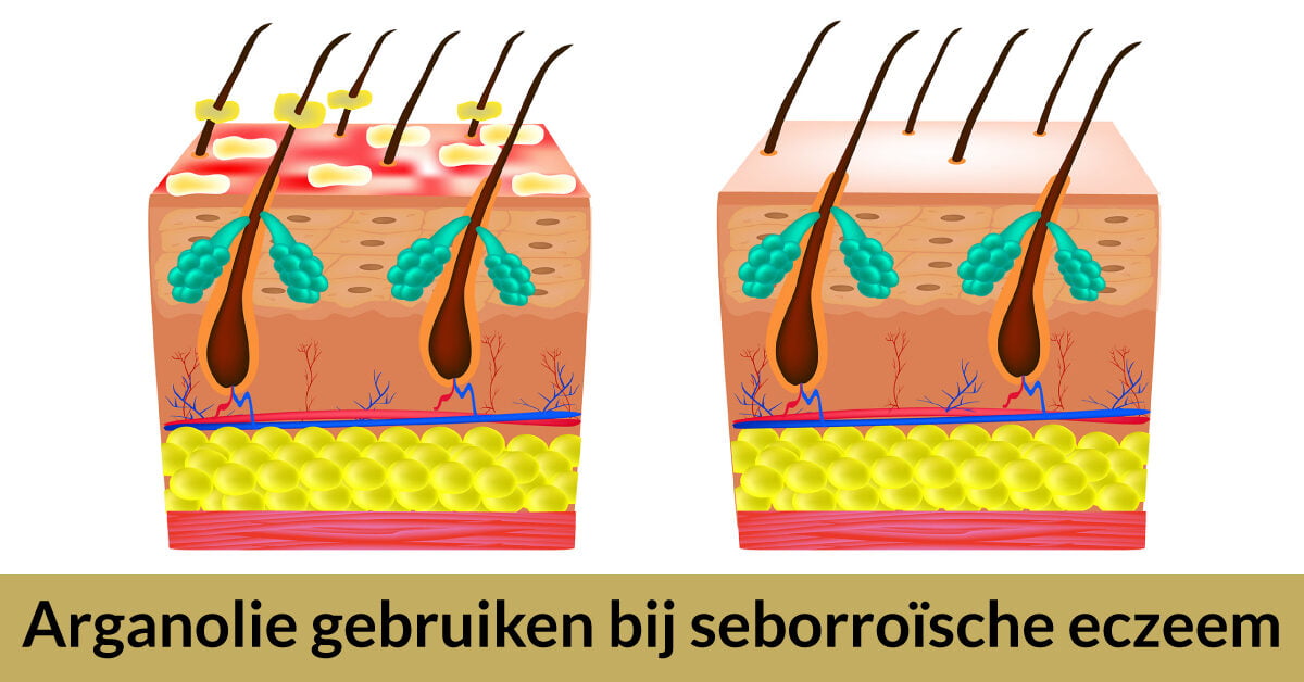 Eczeem voor en na huidverzorging arganolie
