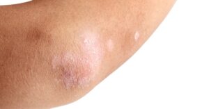 Heb je Last van Ruwe en Droge Ellebogen?