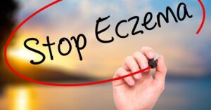 Hoe om te Gaan met Eczeem