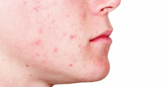 Is Arganolie Effectief in het Behandelen van Acne Littekens?