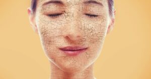 Je Droge Huid Snel Kwijtraken? Volg deze 3 Tips Op!