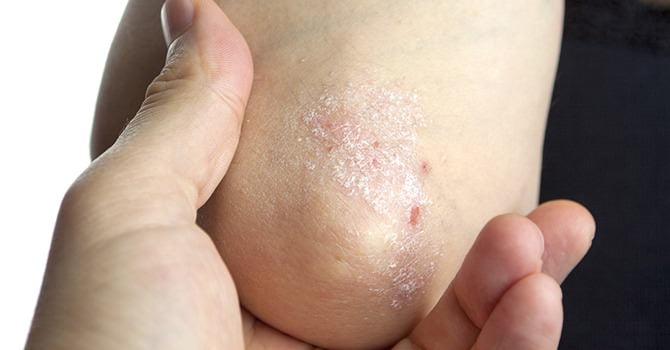 Kun Je Met Arganolie Psoriasis Behandelen?