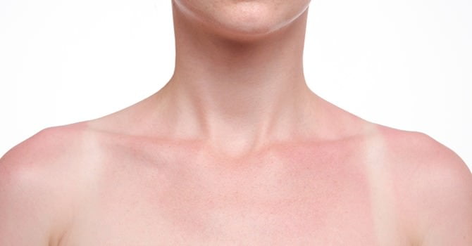 Leer Hier Hoe je een Zonverbrande Huid Kunt Behandelen