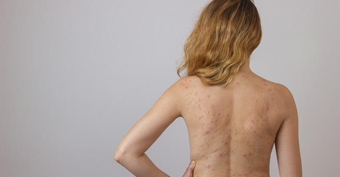 Lees Verder Voor Effectieve Acne Oplossingen!