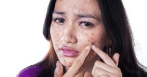 Misschien Ben Je Zelf Wel Schuldig aan Je Acne!