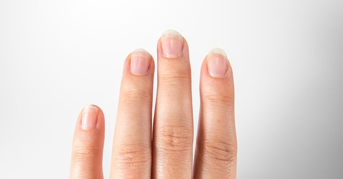 Nagelinfecties, Welke Soorten Zijn Er?