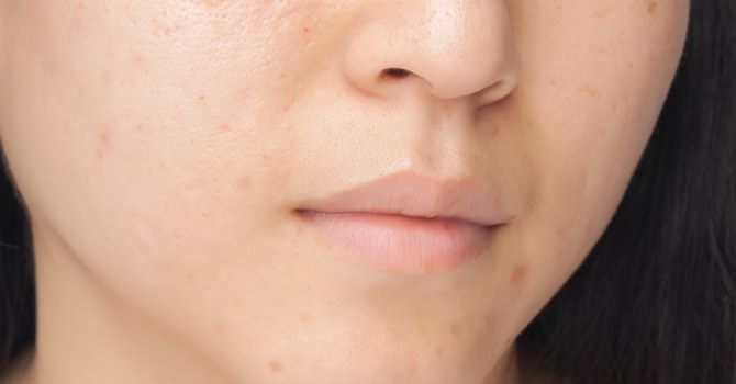 Natuurlijk Behandelingen Tegen Acne Marokkaanse Arganolie