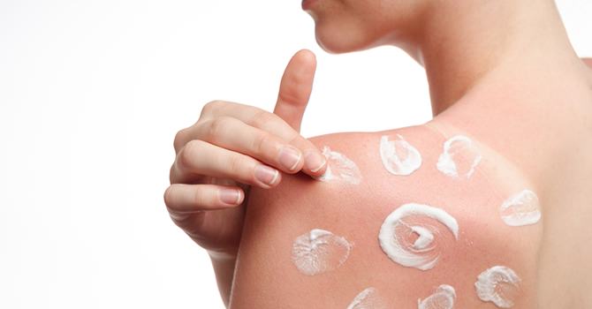 Natuurlijke middeltjes tegen zonnebrand