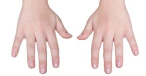 Ontdek de Tekenen van de Nagels die Wijzen op een Voedingstekort