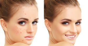 Rosacea Voor en Na