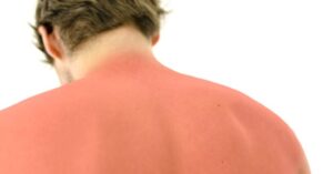 Schade Door de Zon Is Te Herstellen!