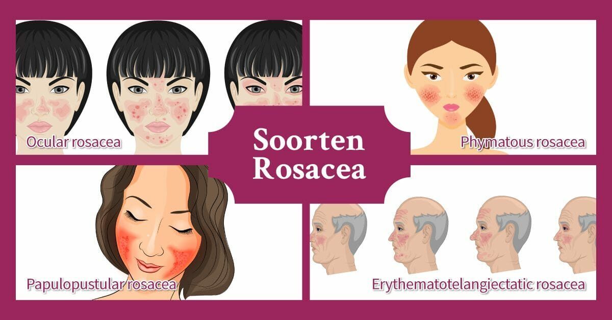Soorten Rosacea roodheid diverse mensen
