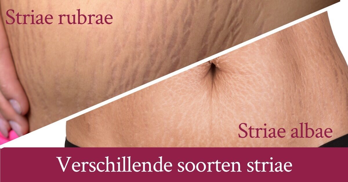 Soorten striae buik