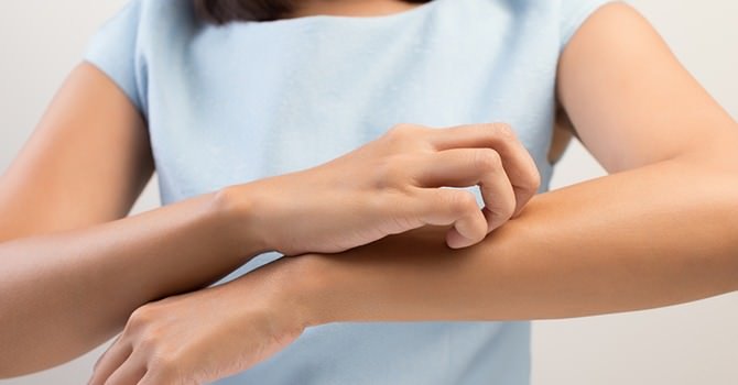 De Symptomen van Eczeem