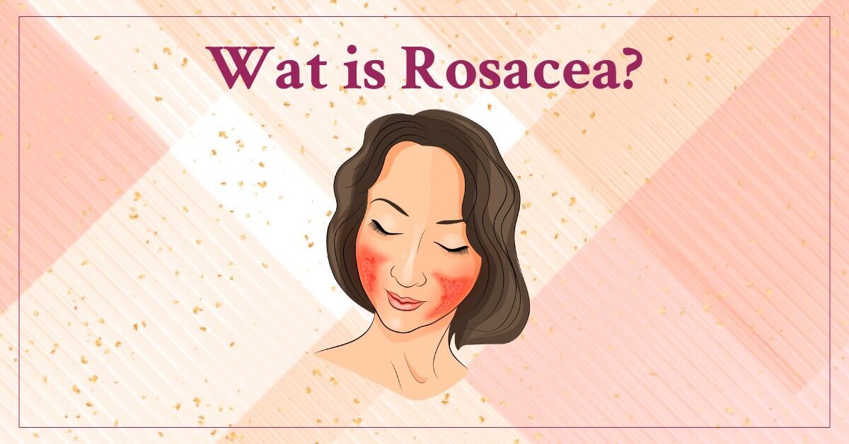 Wat is Rosacea_