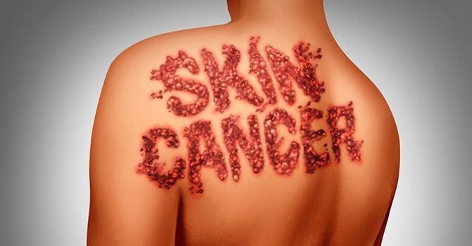 Wat is huidkanker? c