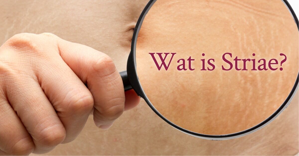 Wat is striae