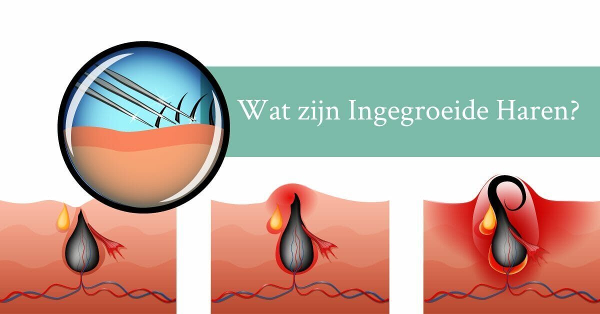 Wat zijn ingegroeide haren_