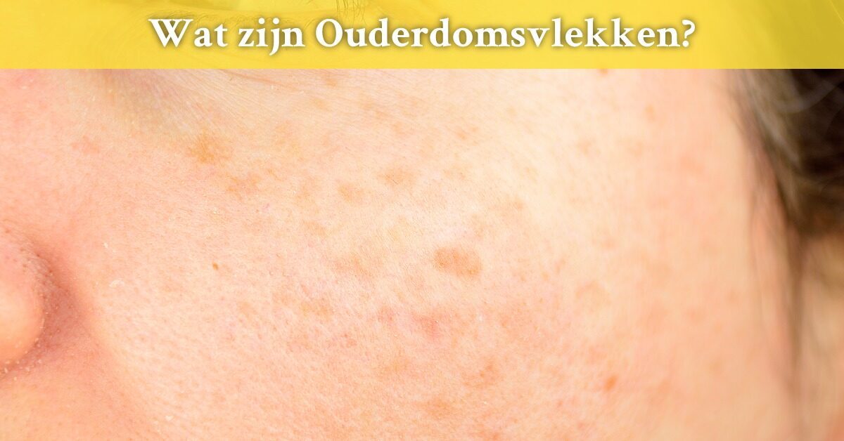 Wat zijn Ouderdomsvlekken