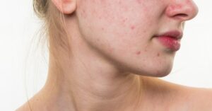 Weet Jij Wat Een Uitbraak Van Acne Kan Veroorzaken?