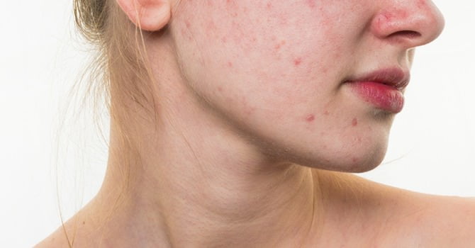 Weet Jij Wat Een Uitbraak Van Acne Kan Veroorzaken?