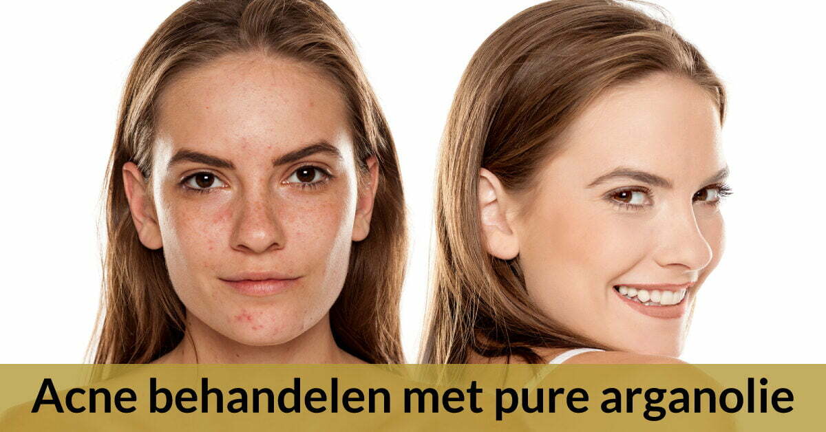 acne behandelen arganolie voor en na vrouw