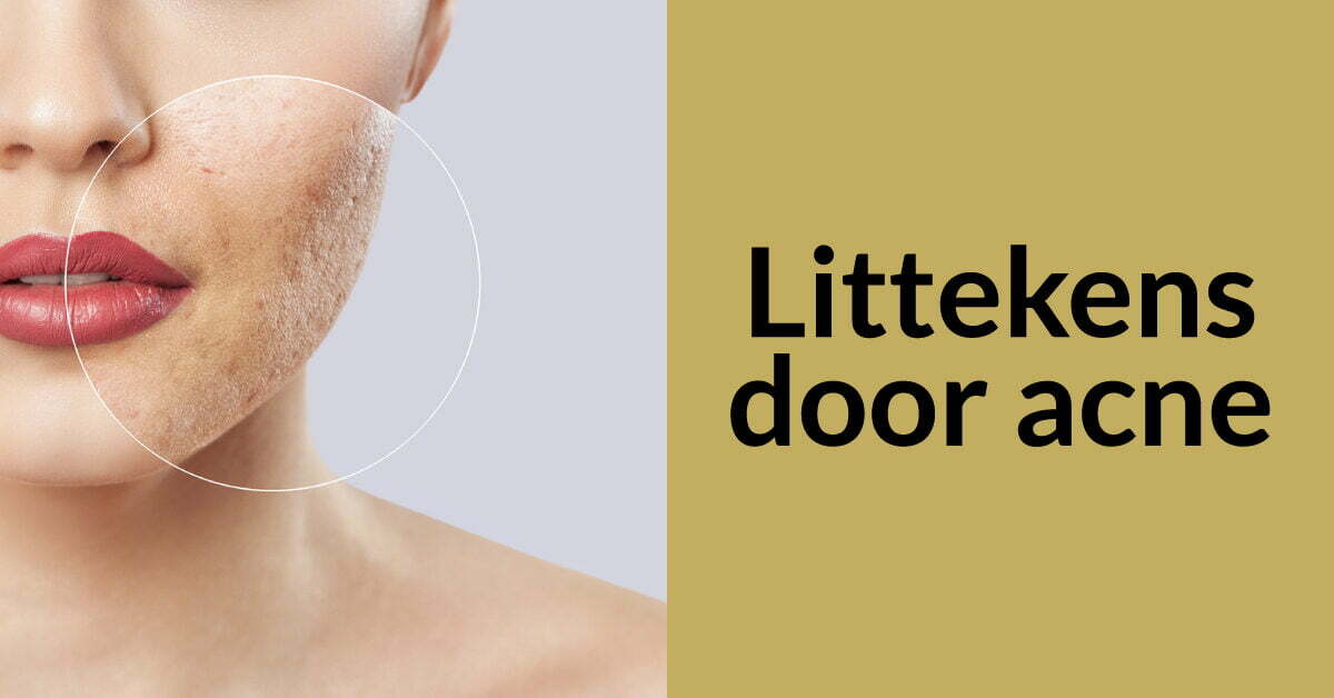 acne littekens gezicht vrouw