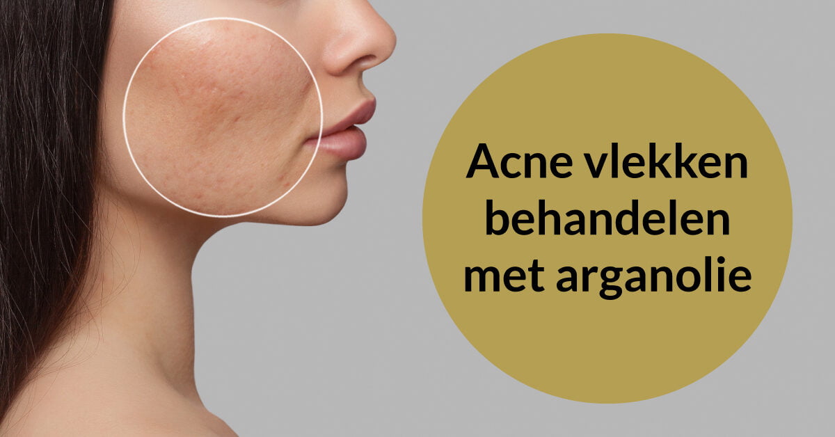 acne vlekken gezicht vrouw behandelen arganolie
