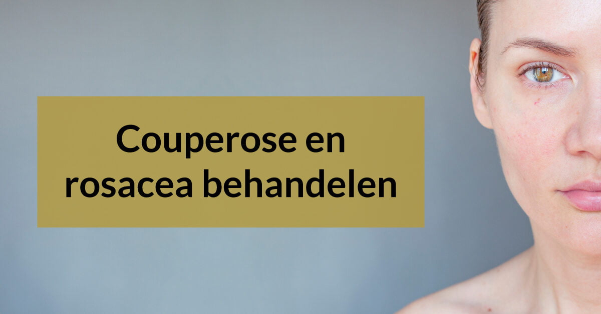 couperose rosacea half gezicht vrouw