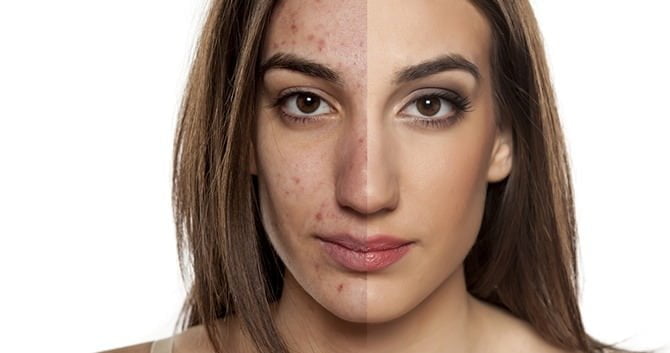 huidveranderingen-tijdens-de-zwangerschap1