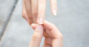 Ingescheurde Nagels