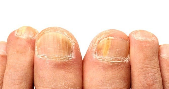 ken-jij-de-meest-voorkomende-nagelinfecties1