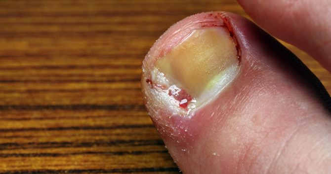 ken-jij-de-meest-voorkomende-nagelinfecties2