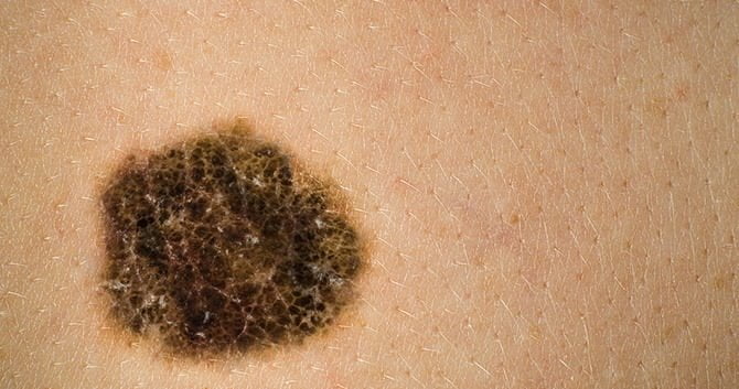melanoom-de-dodelijkste-vorm-van-huidkanker1