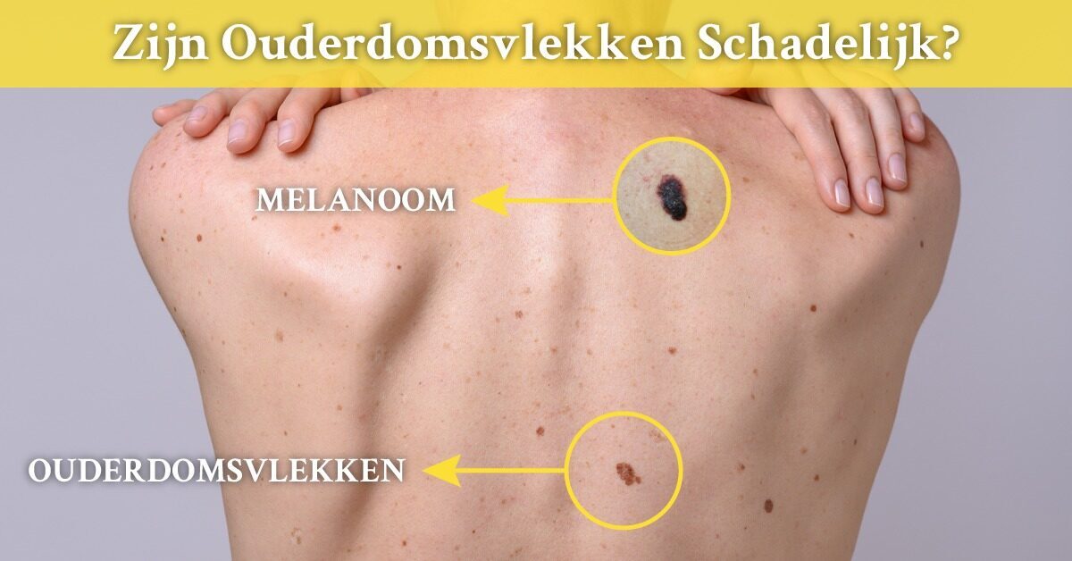 rug vrouw vlekken moedervlekken ouderdomsvlekken melanoom