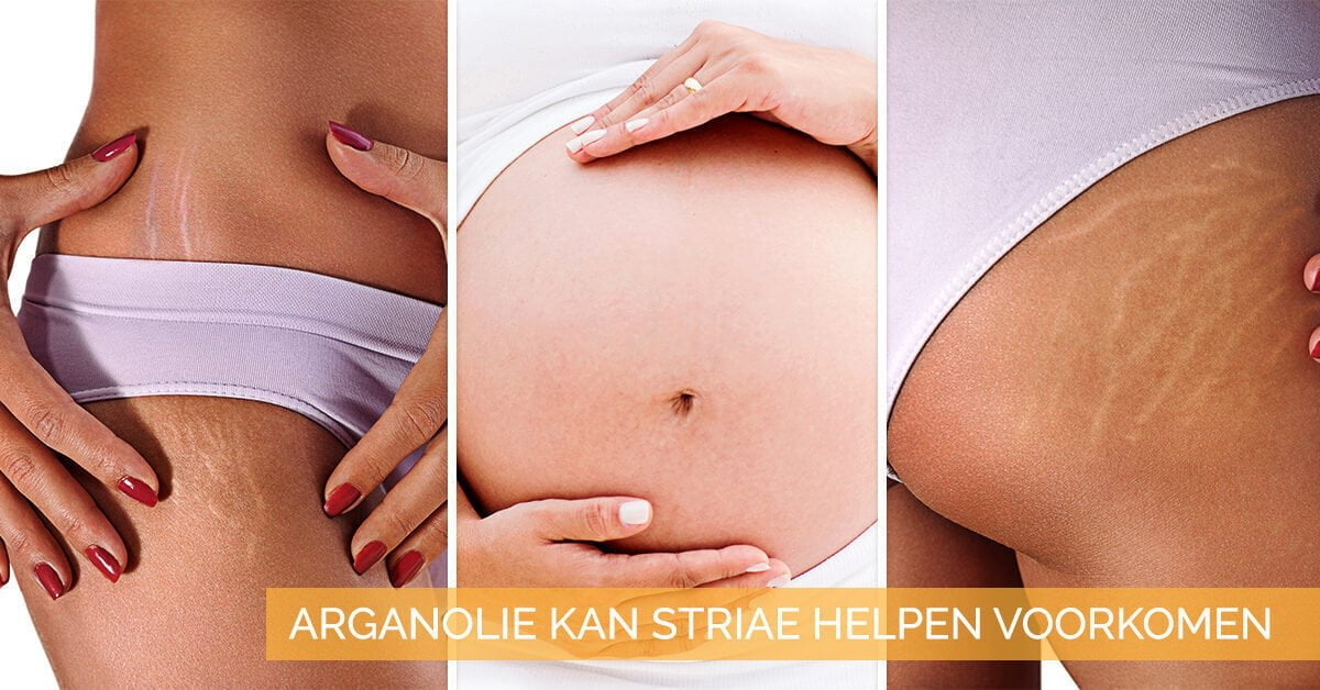 striae zwangerschapsstriemen