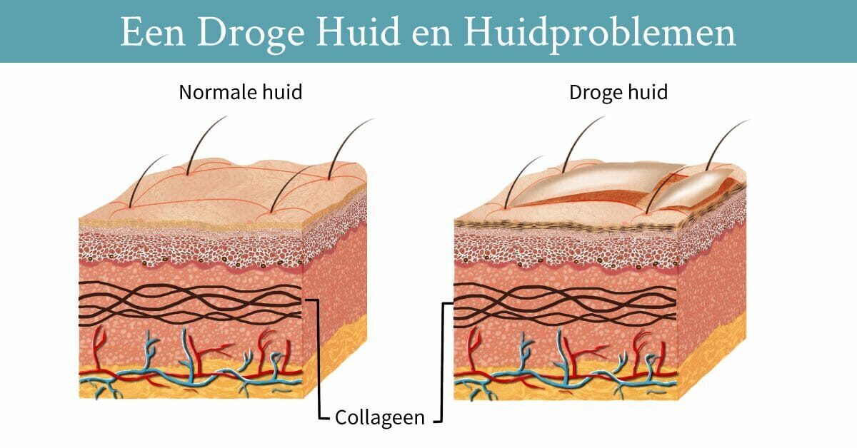verschil normale huid droge huid huidlagen