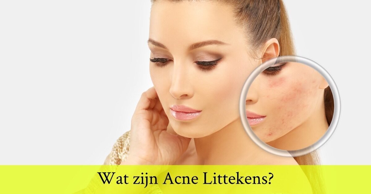 Wat zijn Acne Littekens