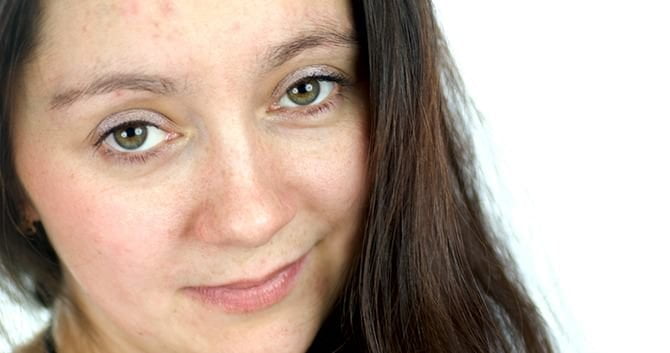 weet-jij-wat-een-uitbraak-van-acne-kan-veroorzaken2